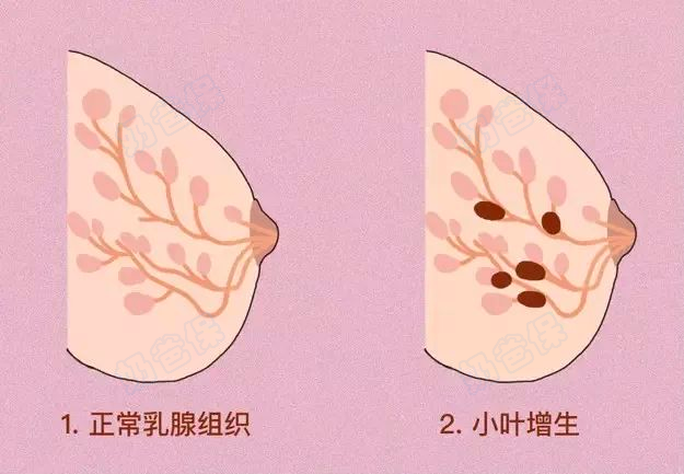 女性乳腺增生